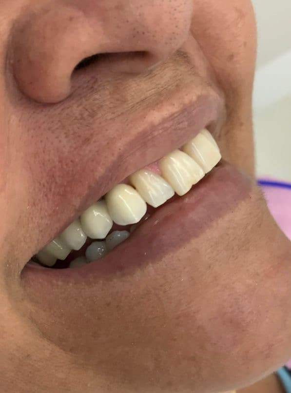 Arcada dentária - Depois