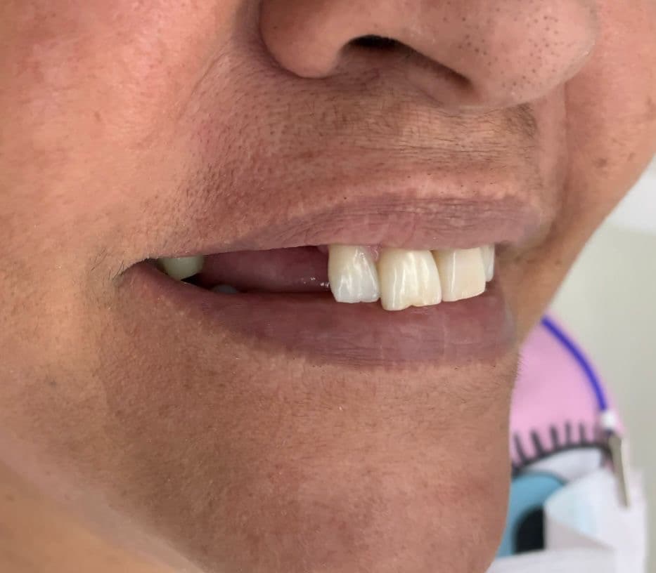 Arcada dentária - Antes